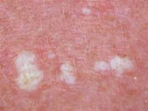 Lichen sclerosus quali sono i sintomi e cosa fare ...