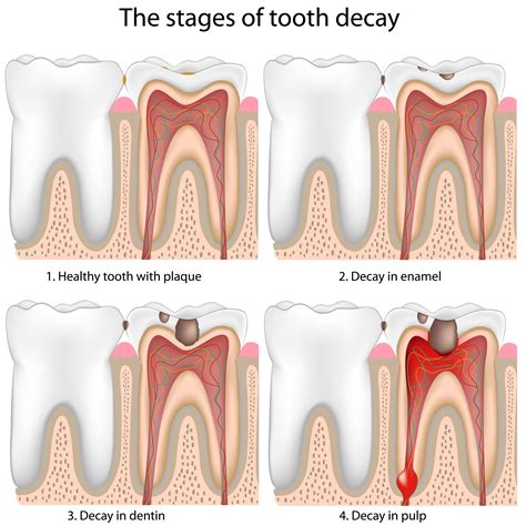 Stages Of Tooth Decay Lake Jackson Tx Restorative Dentistry