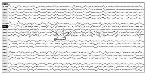 Initial Electroencephalogram Eeg Of The Patient On Admission Showed