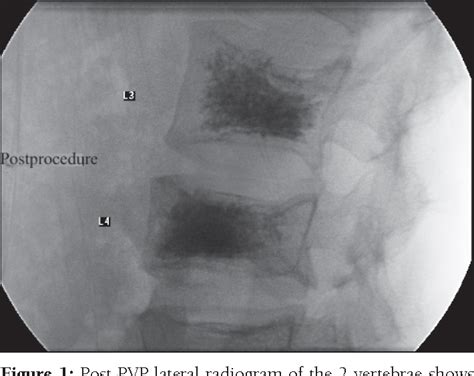 Figure From Percutaneous Vertebroplasty For Osteoporotic Vertebral