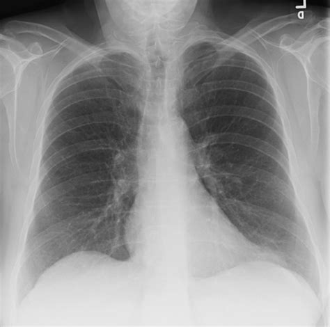 Normal Chest X Ray Images