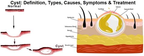 Cyst Definition Types Causes Symptoms Treatment And Pictures