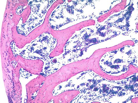 Trabecular Bone