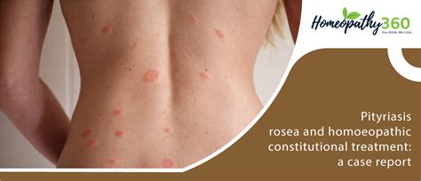 Pityriasis Rosea Rash Symptoms Causes Treatment With Homeopathic Medicine