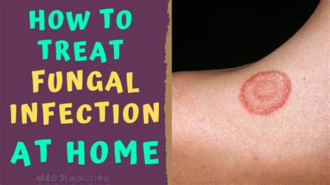 How To Treat Skin Fungal Infection Infection At Home Tinea Ringworm Remedies How To Cure Youtube