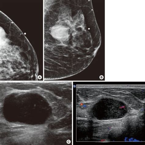 Imaging Findings A B 47 Year Old Woman Resented With A Palpable