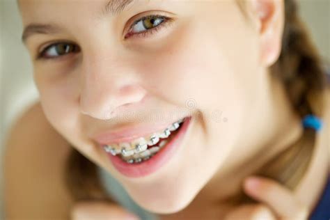 Close Up Portrait Of Smiling Teenager Girl Showing Dental Braces
