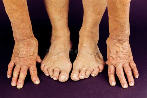 Rrheumatoid Arthritis Hand And Toe Deformities Stock Image Image Of
