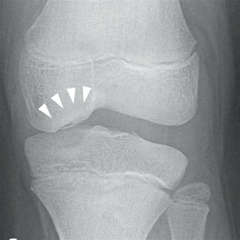 A Lateral View Radiograph Of The Right Knee Showing Brückls Stage Ii