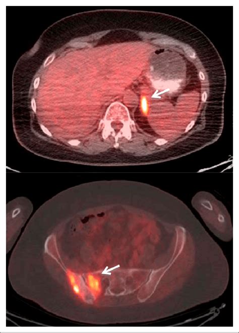 Axial Fused Petct Images Of 60 Y Old Woman With Stage 2b T3n0m0