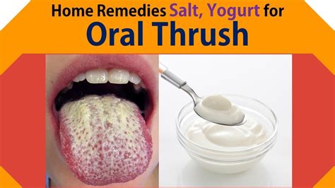 Home Remedies For Oral Thrush Get Rid Oral Thrush With Salt Yogurt