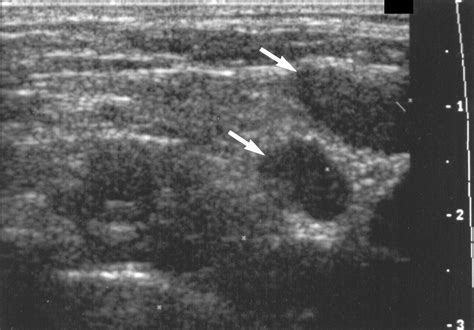 Sonographically Guided Biopsy Of Supraclavicular Lymph Nodes A Simple