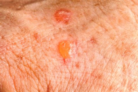 Actinic Keratosis Treatment U S Dermatology Partners