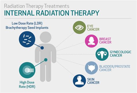 Radiation Therapy Vs Chemotherapy Side Effects All About Radiation