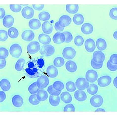 Figure Peripheral Blood Smear Showing Lipid Vacuoles Arrows In