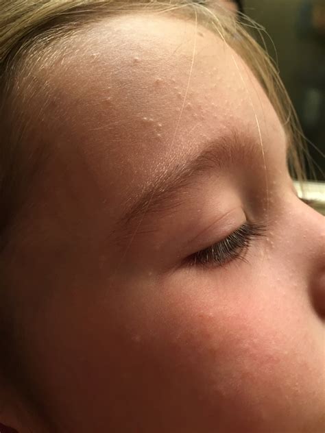 Help With Bumps On Face Eczema Gbcn