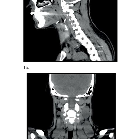 A And 1b The Ct Scan Neck Confirmed The Presence Of Bilateral Large
