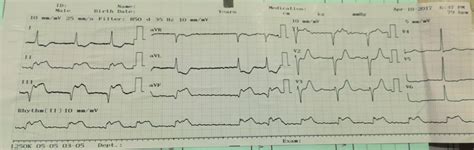 Electrocardiograma De 12 Derivaciones Caso Tres Download Scientific