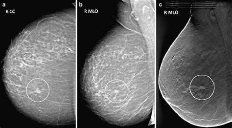 invasive ductal carcinoma ultrasound images
