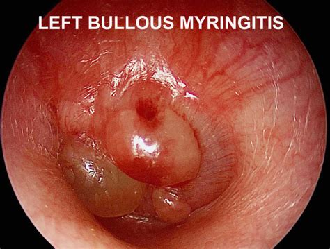 Infectious Myringitis Or Bullous Myringitis Causes Symptoms And Treatment