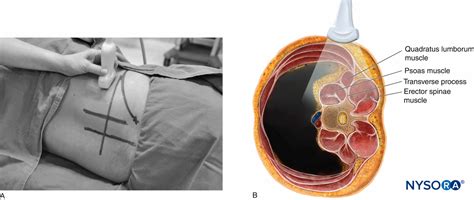 Regional Anesthesia Position Of The Patient Lateral Decubitus And Us