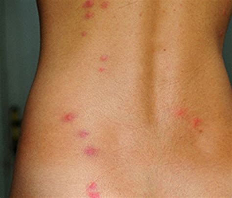 Bed Bug Bite Pictures Marks Symptoms Causes Treatment