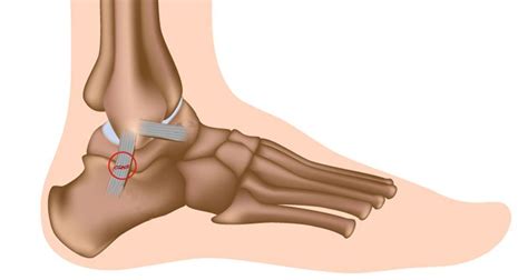 Sprained Ankle Treatment Rehabilitation And Exercises
