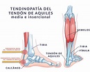 lesiones-del-tendon-de-aquiles | ICONICA Servicios Médicos