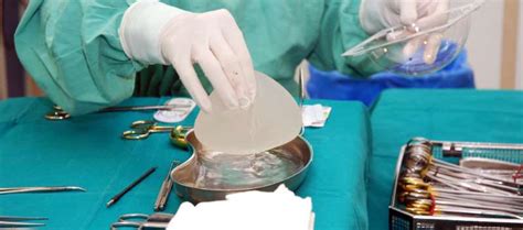 Breast Cancer Survivors Have Increased Risk Of Implant Associated Alcl