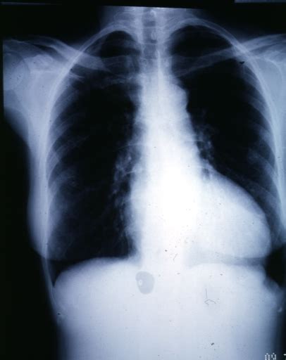 Left Ventricular Hypertrophy Chest X Ray Wikidoc