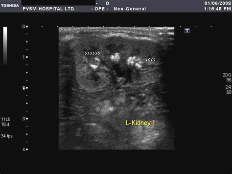 On Radiology Ultrasound Images Of Nephrocalcinosis In Neonates