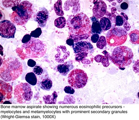 Pathology Outlines Chronic Eosinophilic Leukemia