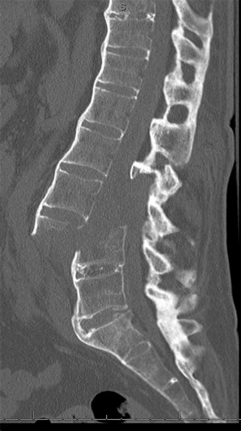 Lumbar Fracture X Ray
