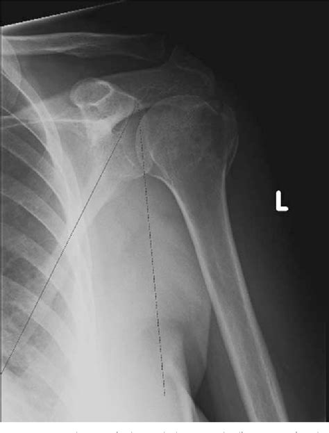 Figure 37 6 From Glenoid Fractures Scapular Neck Fracture The Superior