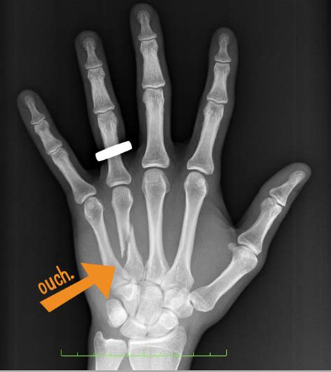 Broken Hand Causes Symptoms And Treatment Tanya Coats