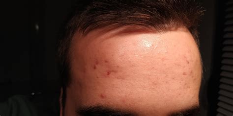 Skin Concerns Red Spots On Forehead Rskincareaddiction