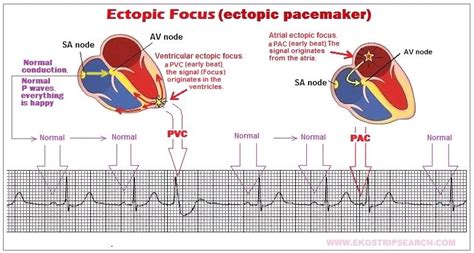 To focus on, or be preoccupied with. What is a ventricular escape beat?