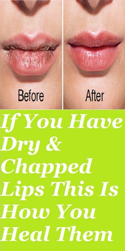 If You Have Dry And Chapped Lips This Is How You Heal Them Chapped