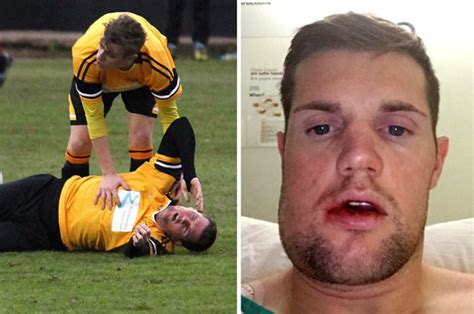 Footballer Scarred For Life After One Punch Broke His Jaw During Match Daily Star