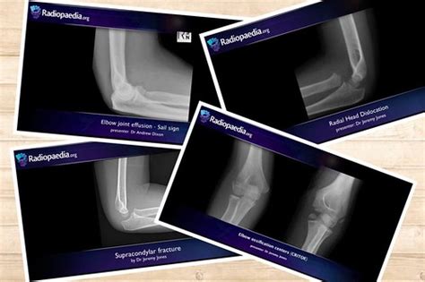 Radiologychannels “pediatric Elbow Series” Four Great F Flickr
