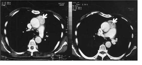 Figure 2 From Mediastinal Paraganglioma Irrigated By Coronary Vessels