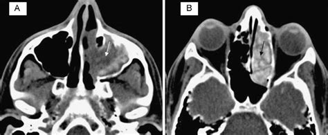 A And B Selected Unenhanced Axial Ct Scans Of The Paranasal Sinuses