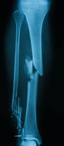 270 Broken Leg Xray Stock Photos Pictures And Royalty Free Images Istock