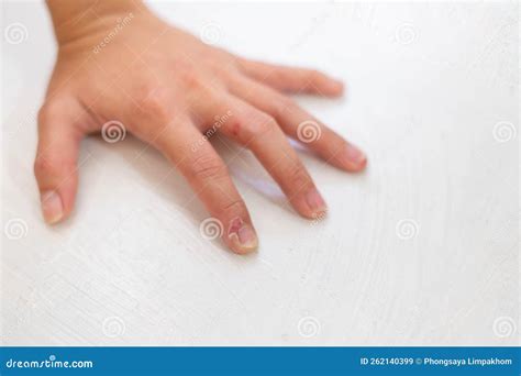 Close Up Of Fingers Female Hand With Dry Cracked Skin On Cuticles