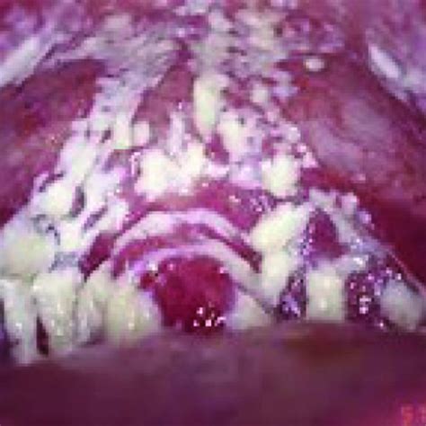 Vulvovaginal Candidiasis The Dirty Low Down On Yeast Infection