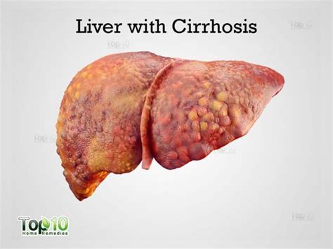 Cirrhosis is characterized by the formation of regenerative nodules in liver parenchyma surrounded by fibrous septa due to chronic liver injury. Home Remedies for Cirrhosis of the Liver | Top 10 Home ...