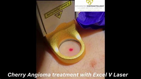 Cherry Angioma Treatment With Excel V Laser Youtube