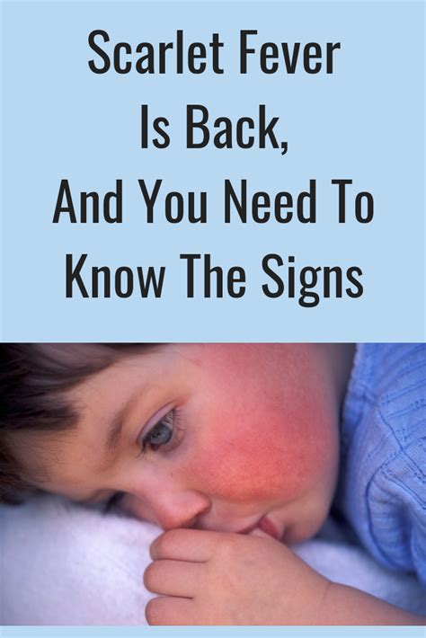 Scarlet Fever Is Back And You Need To Know The Signs Scarlet Fever