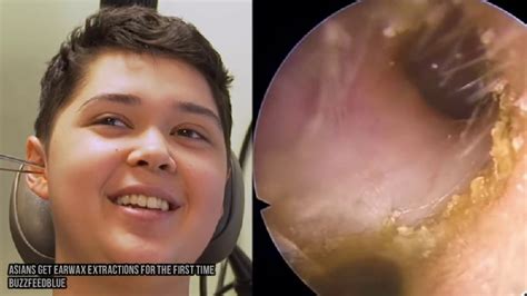 Ear Foreign Body Removal Bugs And Ear Wax Removal Youtube