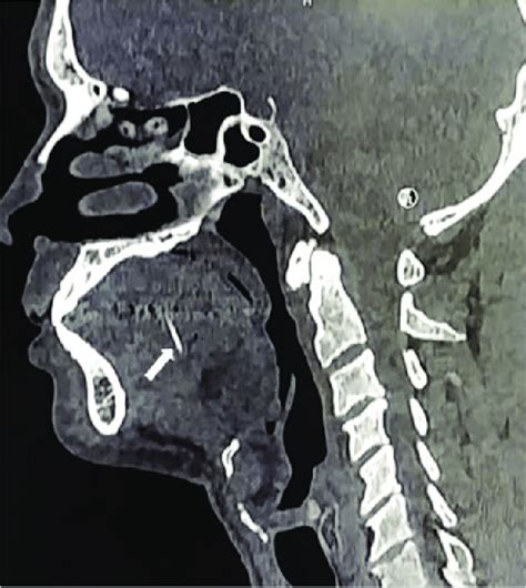 Sagittal Computed Tomography Scan Of The Neck First Ct Scan Showing A